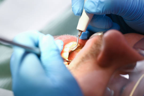 Best Dentist for Tooth Abscess  in Belle Isle, FL
