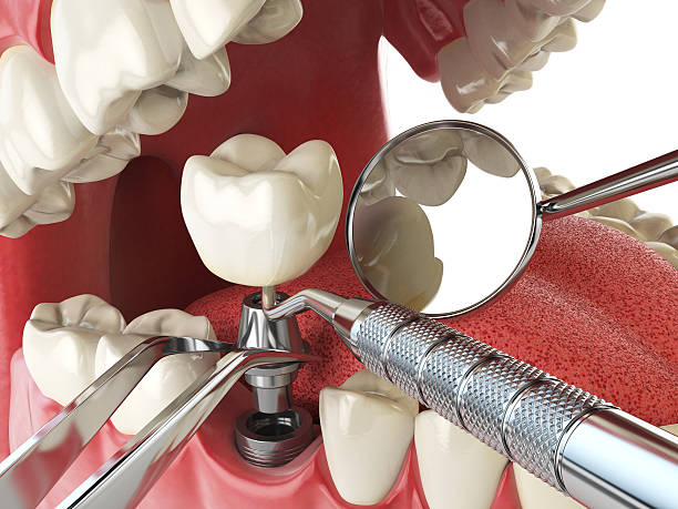 Best Knocked-Out Tooth Emergency  in Belle Isle, FL